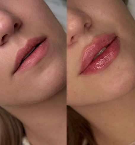 "subtiel en natuurlijk" Vergelijking van lippen voor en na een lipfillerbehandeling, met een glanzende finish.