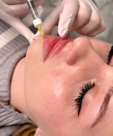 "Erg blij mee" Een cliënte na een lipfillerbehandeling, met een glanzende finish. Door arts van cosmedisch.com